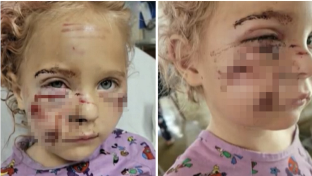 5 year old girl mauled by dog